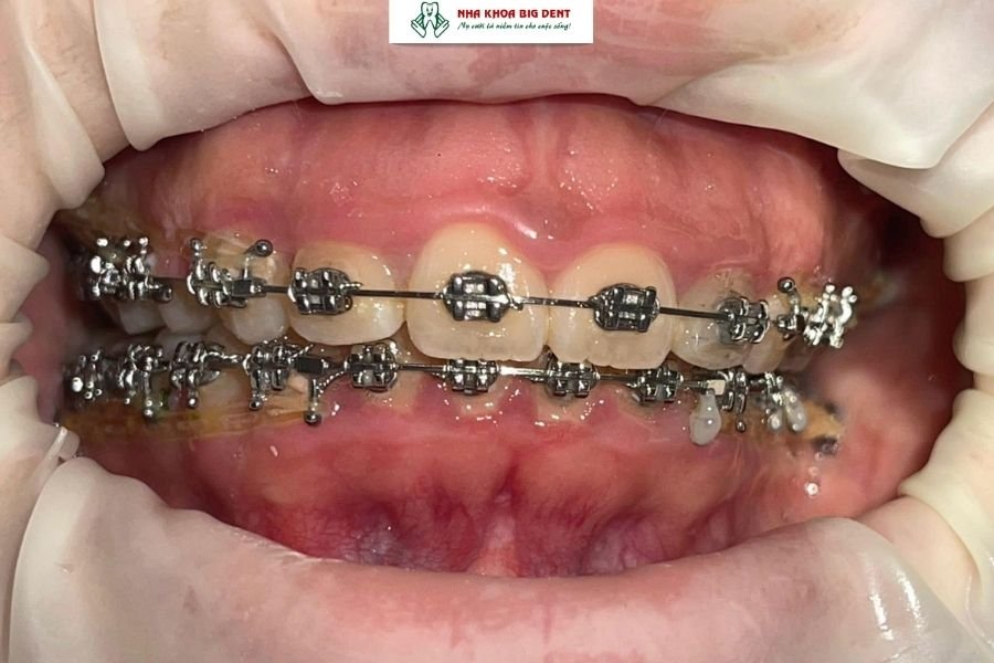 niềng răng có hết hô không