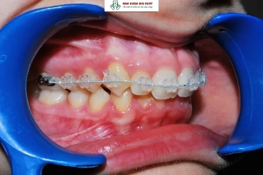 niềng răng hô nướu