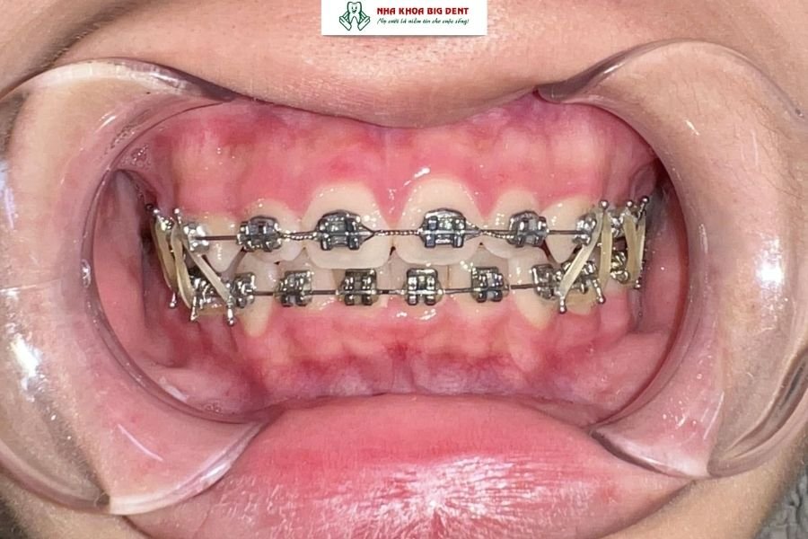 niềng răng hô vẩu