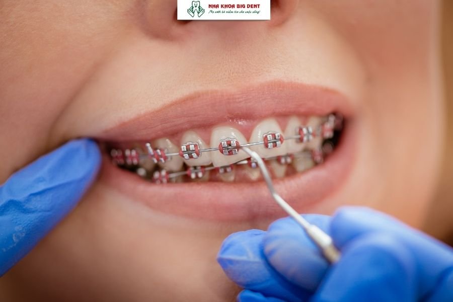 niềng răng mắc cài kim loại