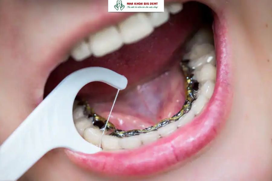 Niềng răng móm bằng mắc cài mặt trong.