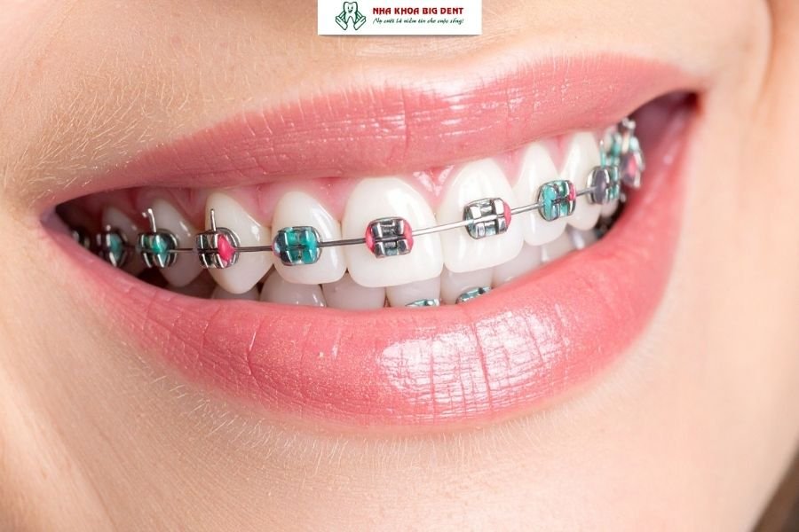 niềng răng móm bằng mắc cài thường