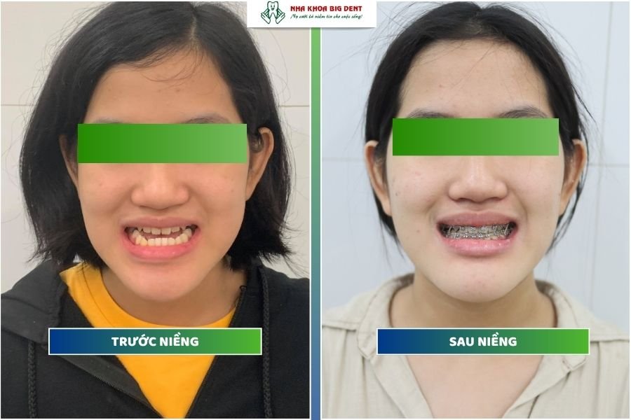 Niềng răng móm
