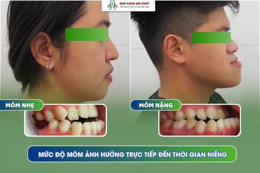 niềng răng móm