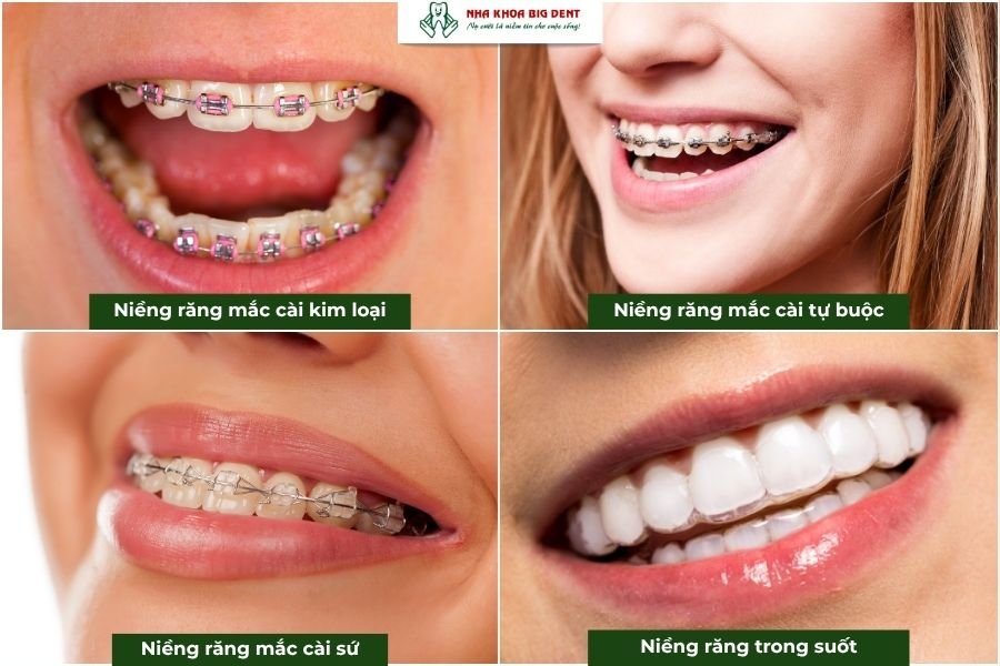 niềng răng hô bao nhiêu tiền phụ thuộc phần lớn vào phương pháp chỉnh nha