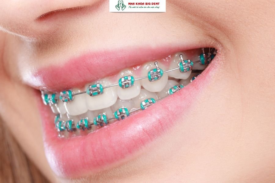 niềng răng mắc cài kim loại