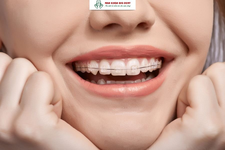 niềng răng mắc cài sứ