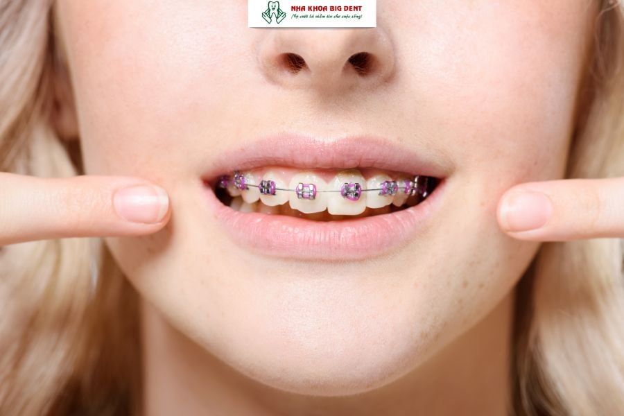 Niềng răng mắc cài kim loại