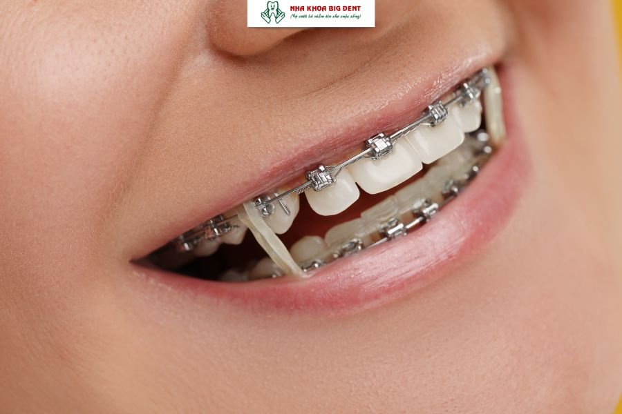 niềng răng mắc cài tự buộc