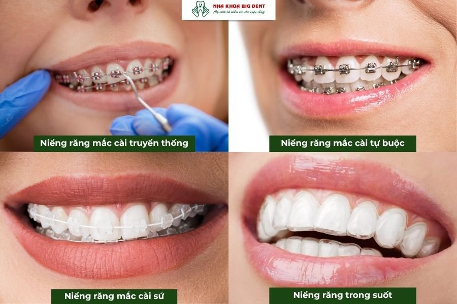 phương pháp niềng răng