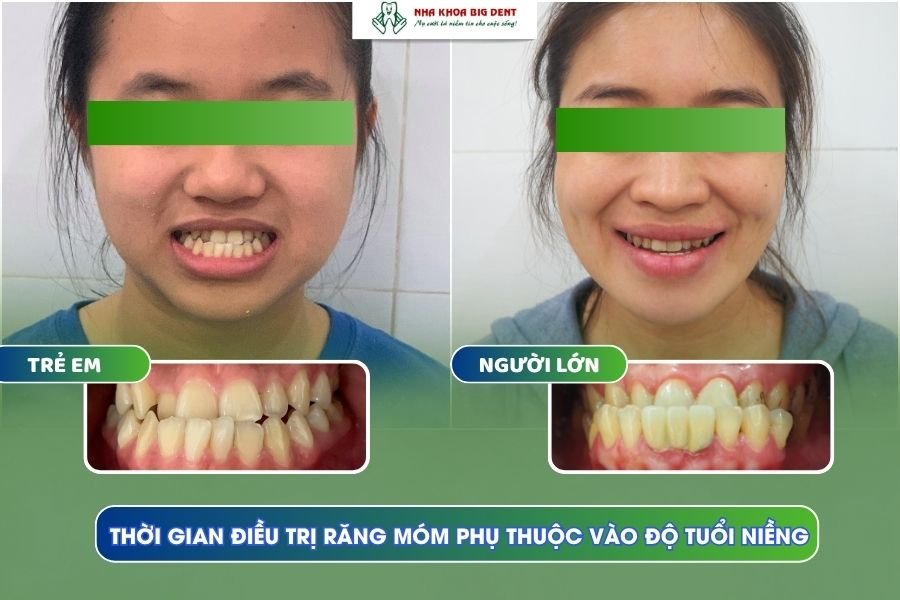 tuổi niềng răng
