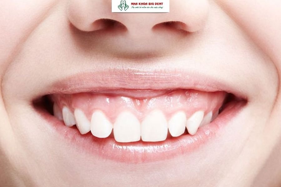 lợi phát triển quá mức