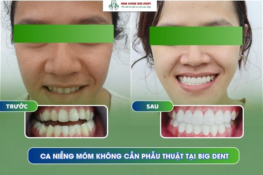 Niềng răng móm không cần phẫu thuật