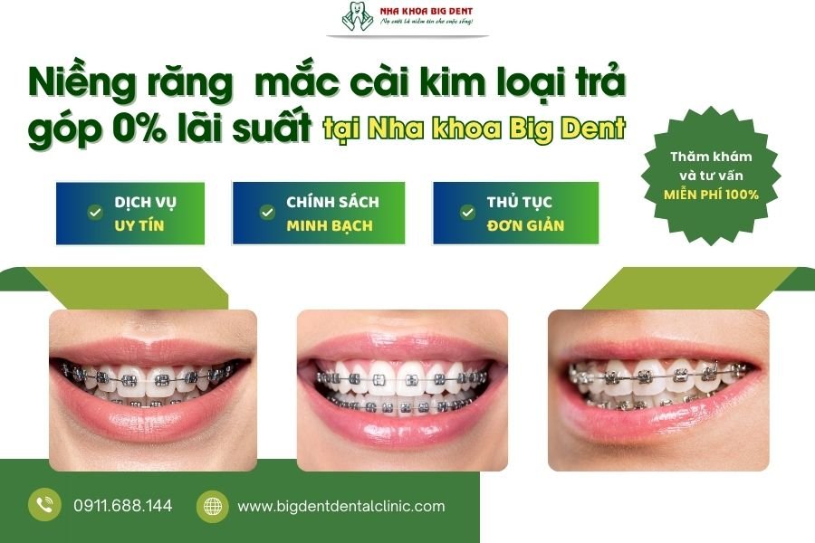 niềng răng mắc cài kim loại trả góp