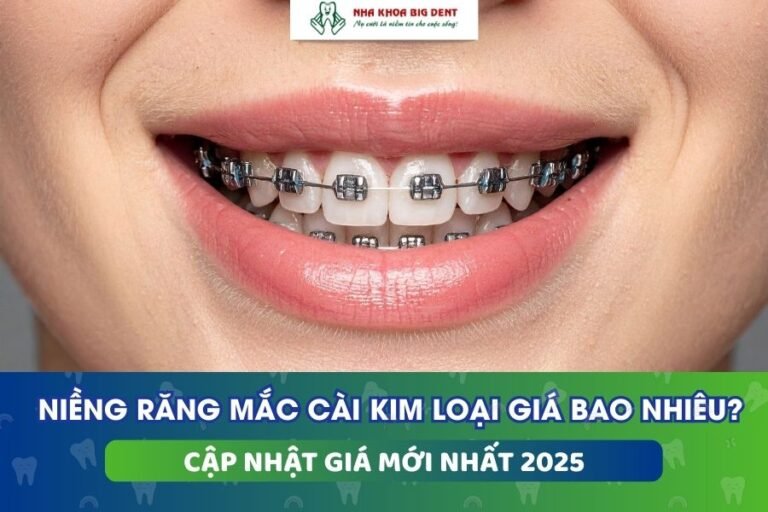 giá niềng răng mắc cài kim loại