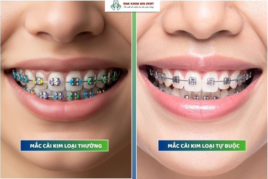 giá niềng răng mắc cài kim loại