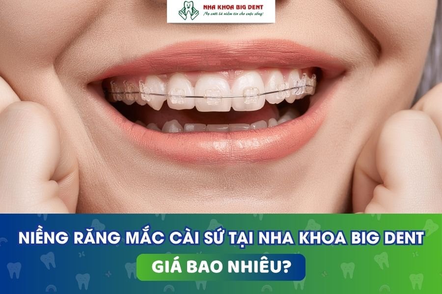 Giá niềng răng mắc cài sứ