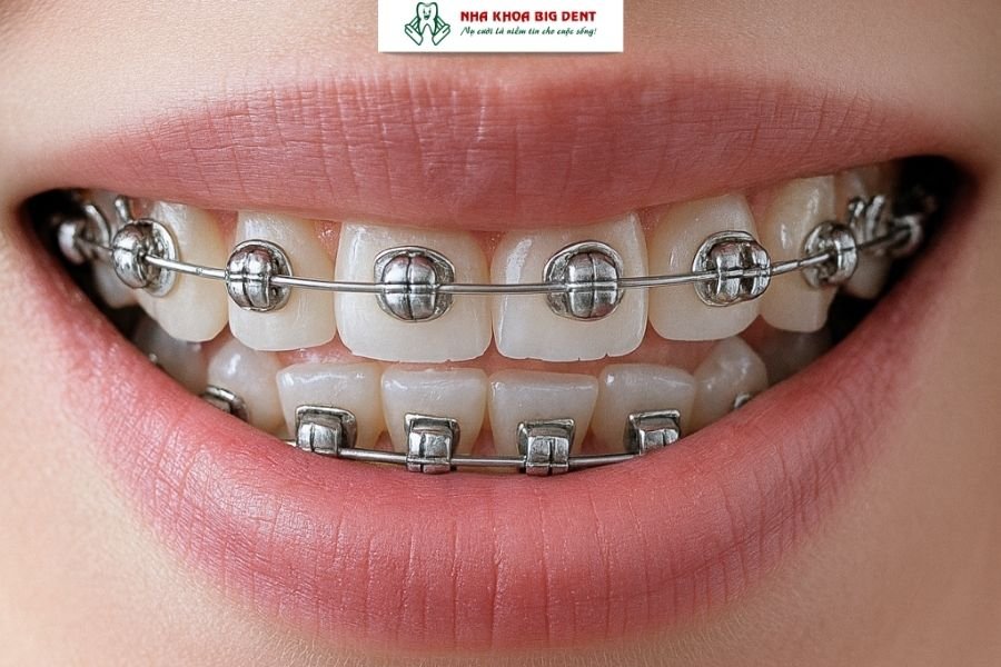 mắc cài cánh cam