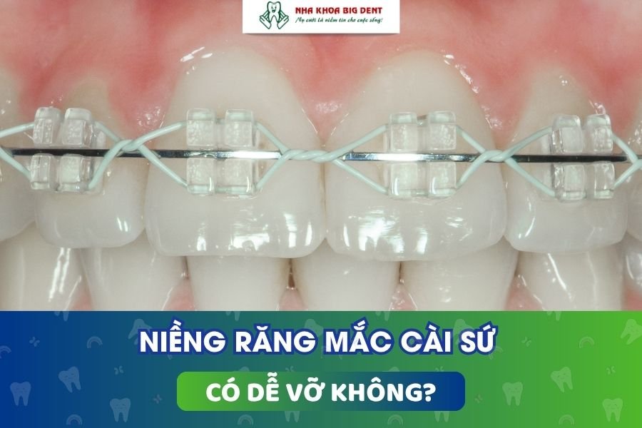 Niềng răng mắc cài sứ có dễ vỡ không.