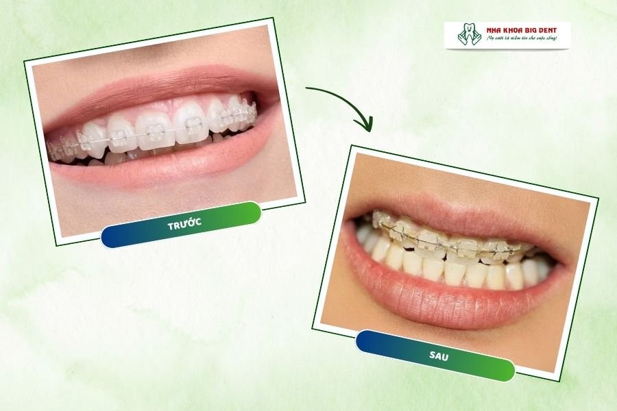 mắc cài sứ bị vàng