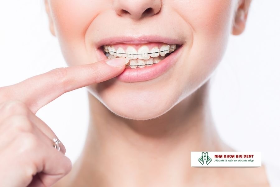 niềng răng mắc cài sứ có dễ vỡ không