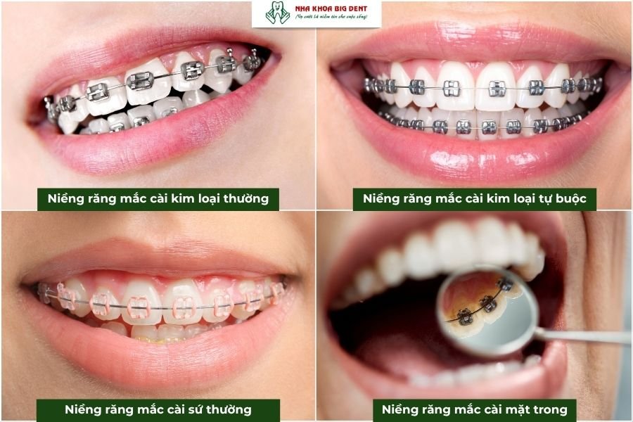 niềng răng mắc cài