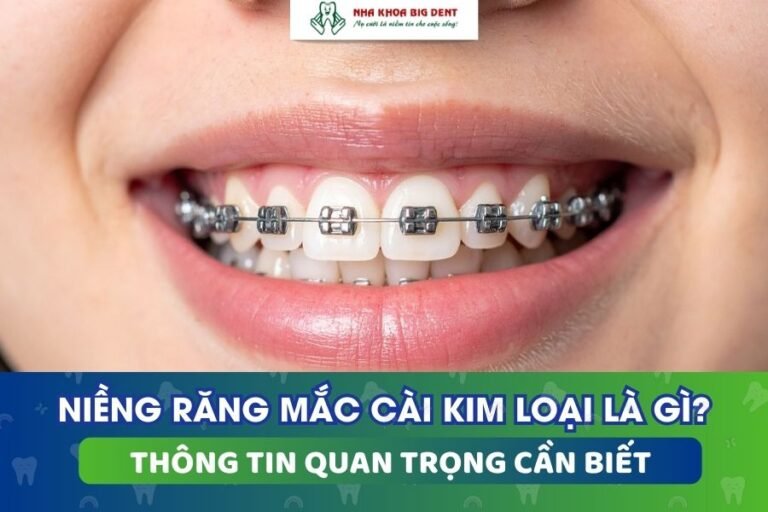 niềng răng mắc cài kim loại là gì