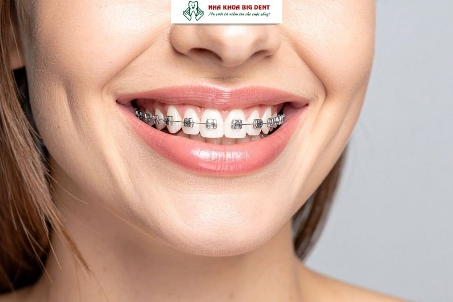 niềng răng mắc cài kim loại