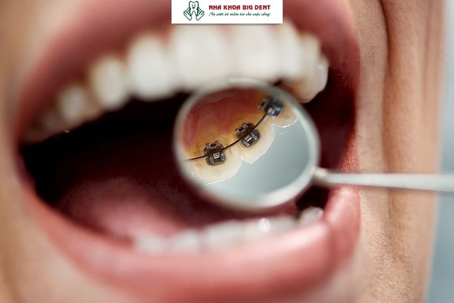 niềng răng mắc cài mặt trong