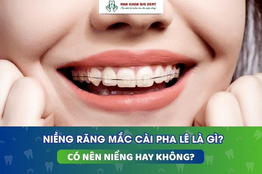 niềng răng mắc cài pha lê