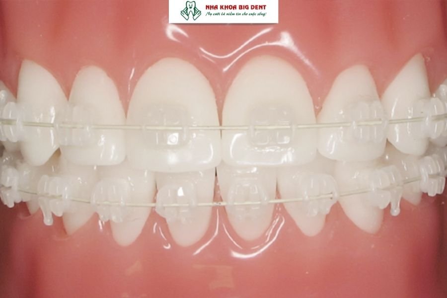 niềng răng mắc cài pha lê