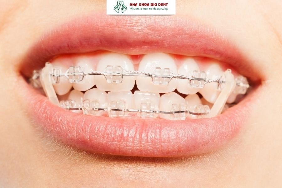 niềng răng mắc cài pha lê