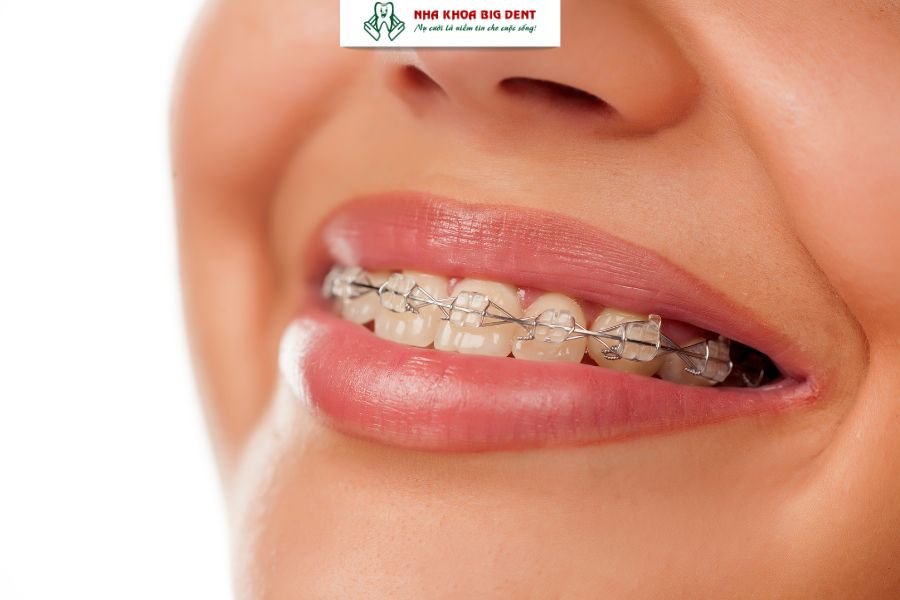 niềng răng mắc cài sứ