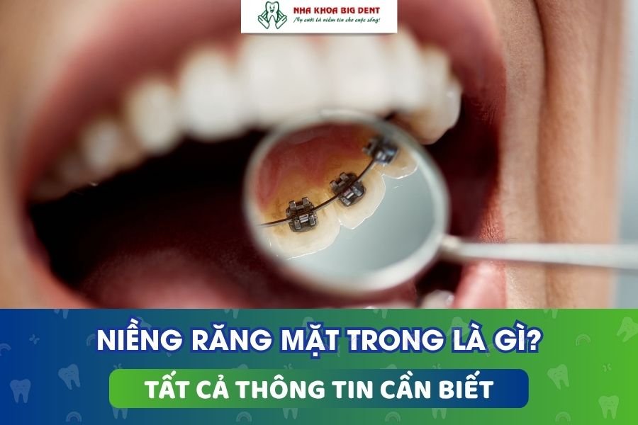 niềng răng mặt trong