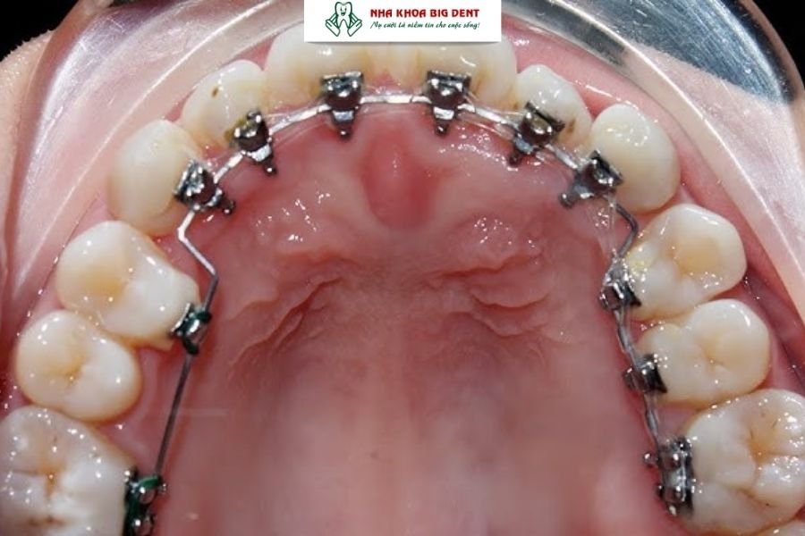 niềng răng mặt trong