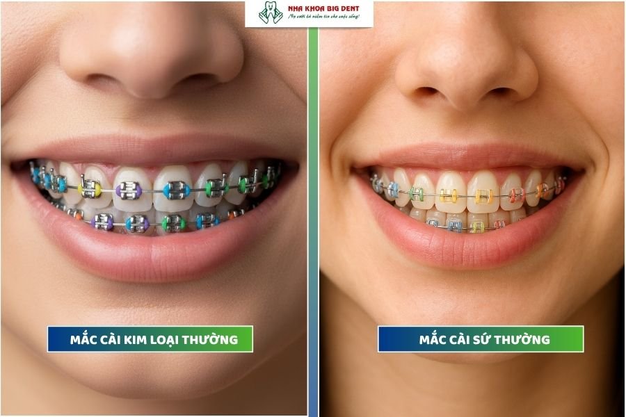 Niềng răng bằng mắc cài thường