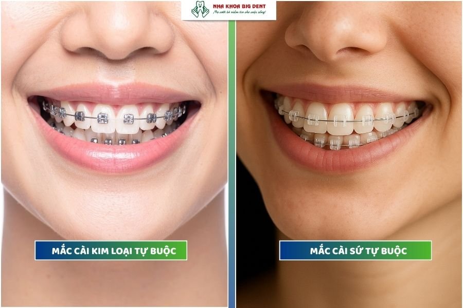 niềng răng mắc cài tự buộc