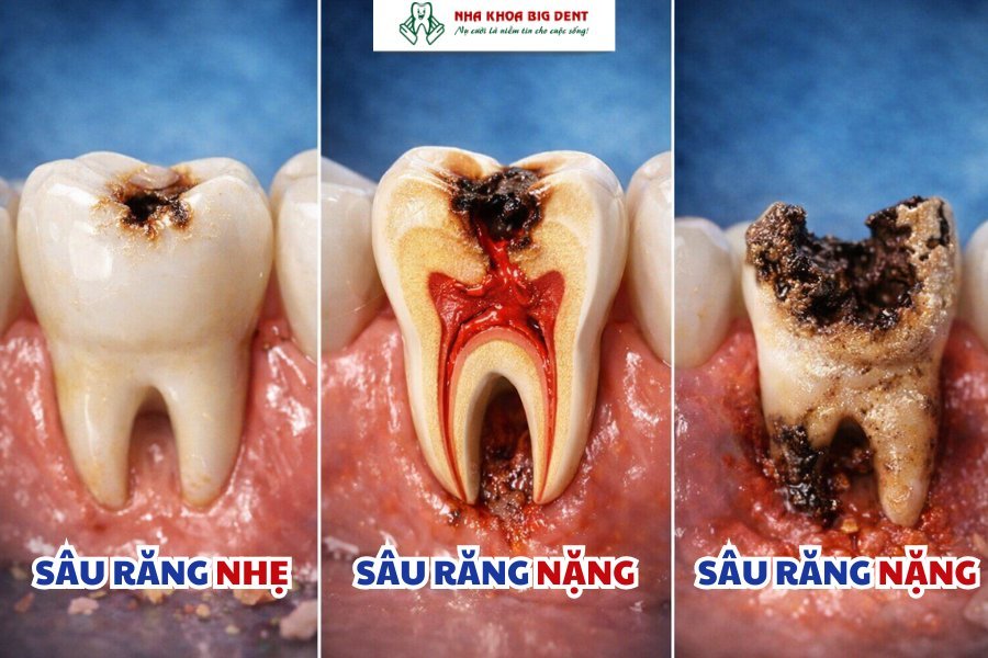 sâu răng