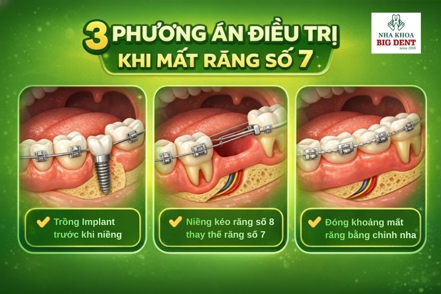 mất răng số 7 có niềng răng được không
