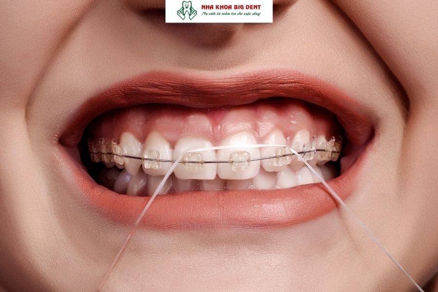 niềng răng mắc cài sapphire