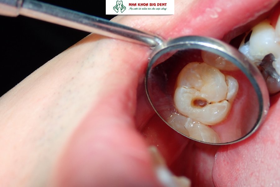 sâu răng có niềng được không