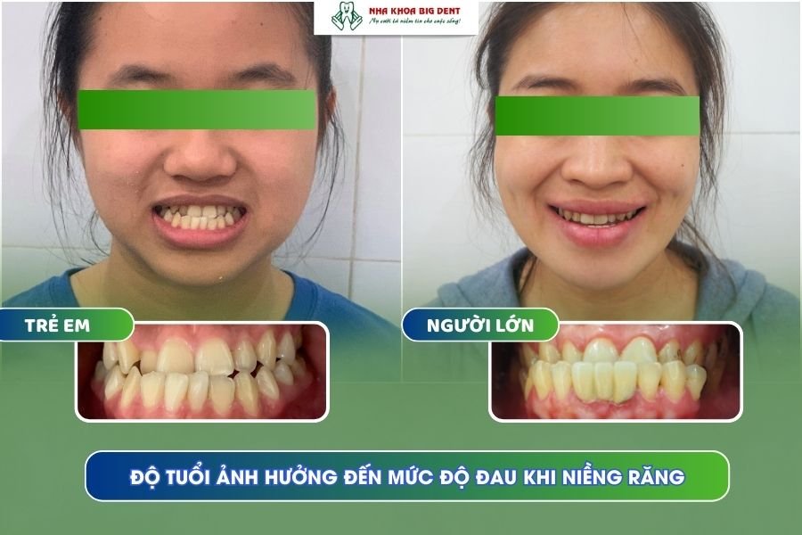 Độ tuổi niềng răng