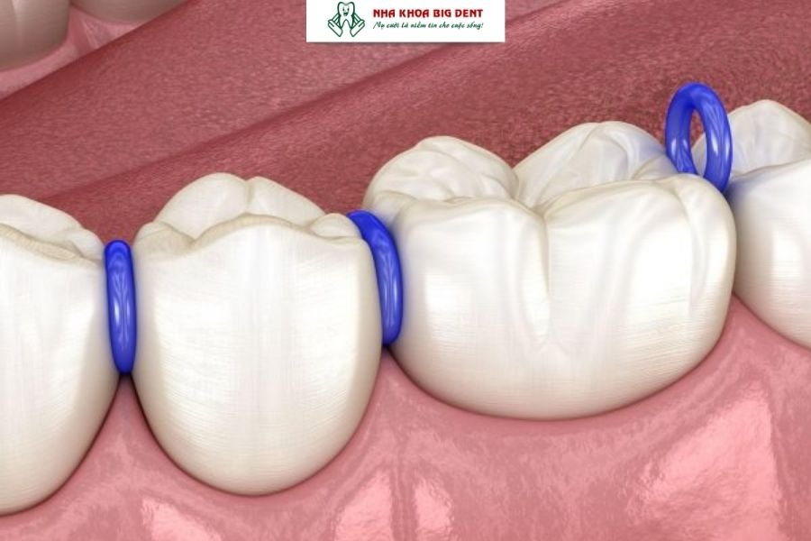 đặt thun tách kẽ