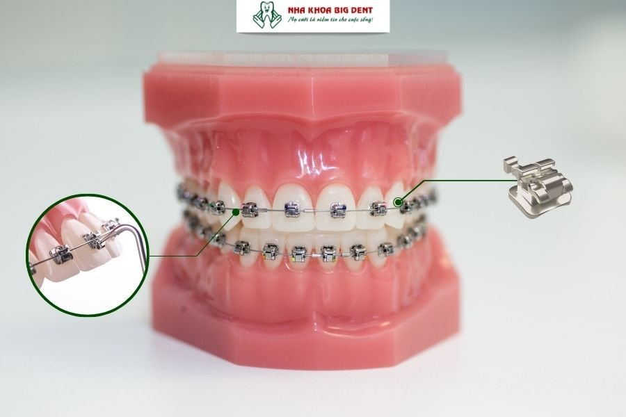 niềng răng mắc cài tự buộc