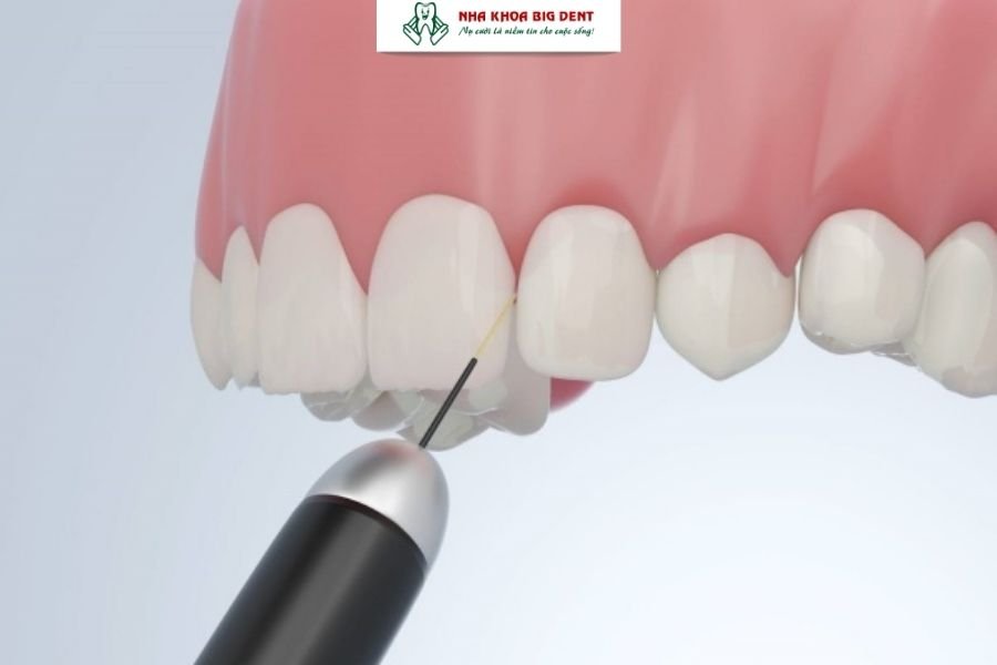 mài kẽ răng