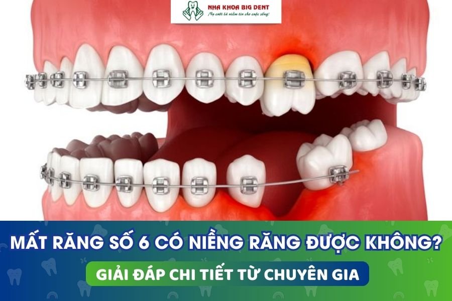 mất răng số 6 có niềng được không