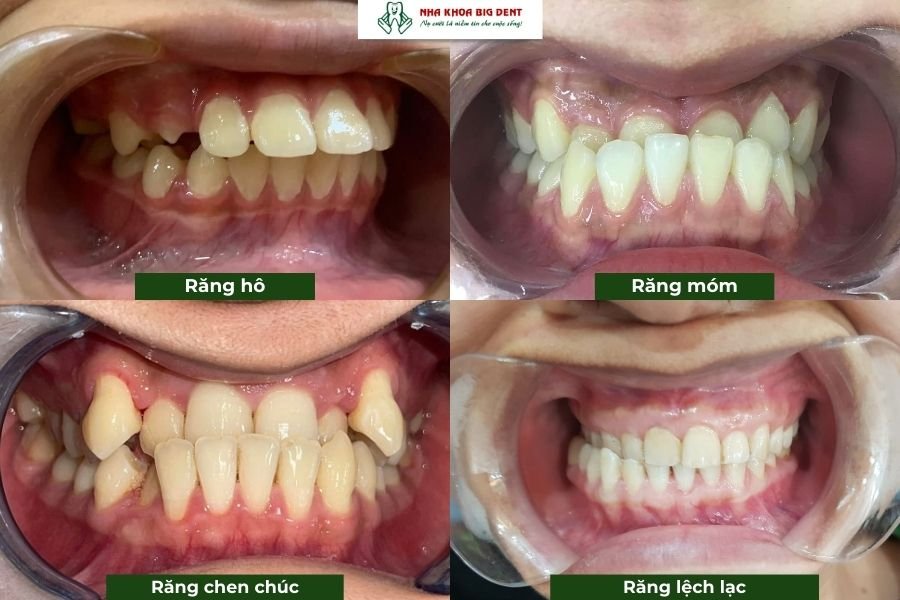 Mức độ lệch lạc răng