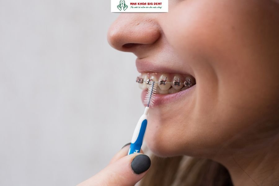 vệ sinh răng miệng khi niềng răng