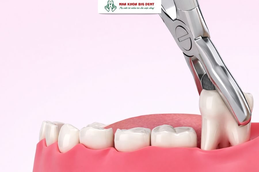 niềng răng có cần nhổ răng khôn không