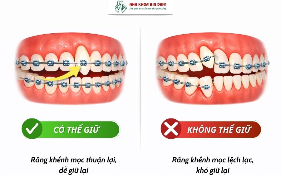 niềng răng giữ lại răng khểnh có được không
